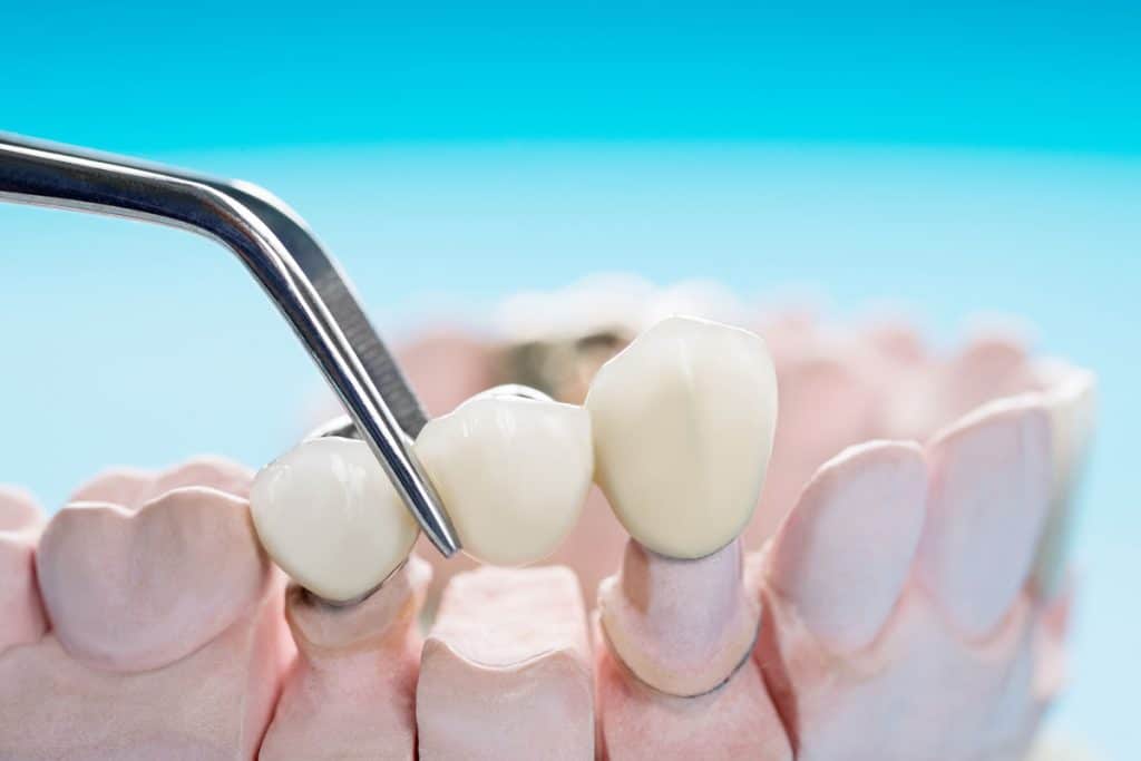 How Much Do Dental Bridges Cost in Foggy Bottom, Washington, DC?